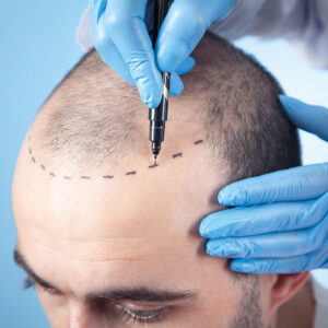 best hair transplant in lahore