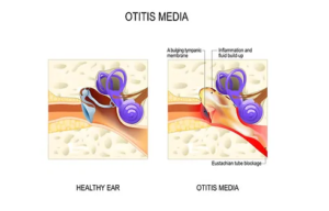 Otitis Media in Adults: Middle Ear Infection Causes and Symptoms